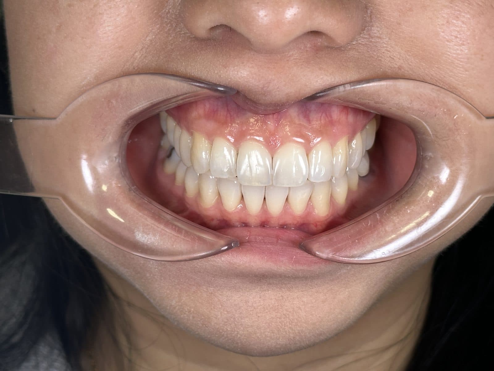 After: close-up of teeth and gums