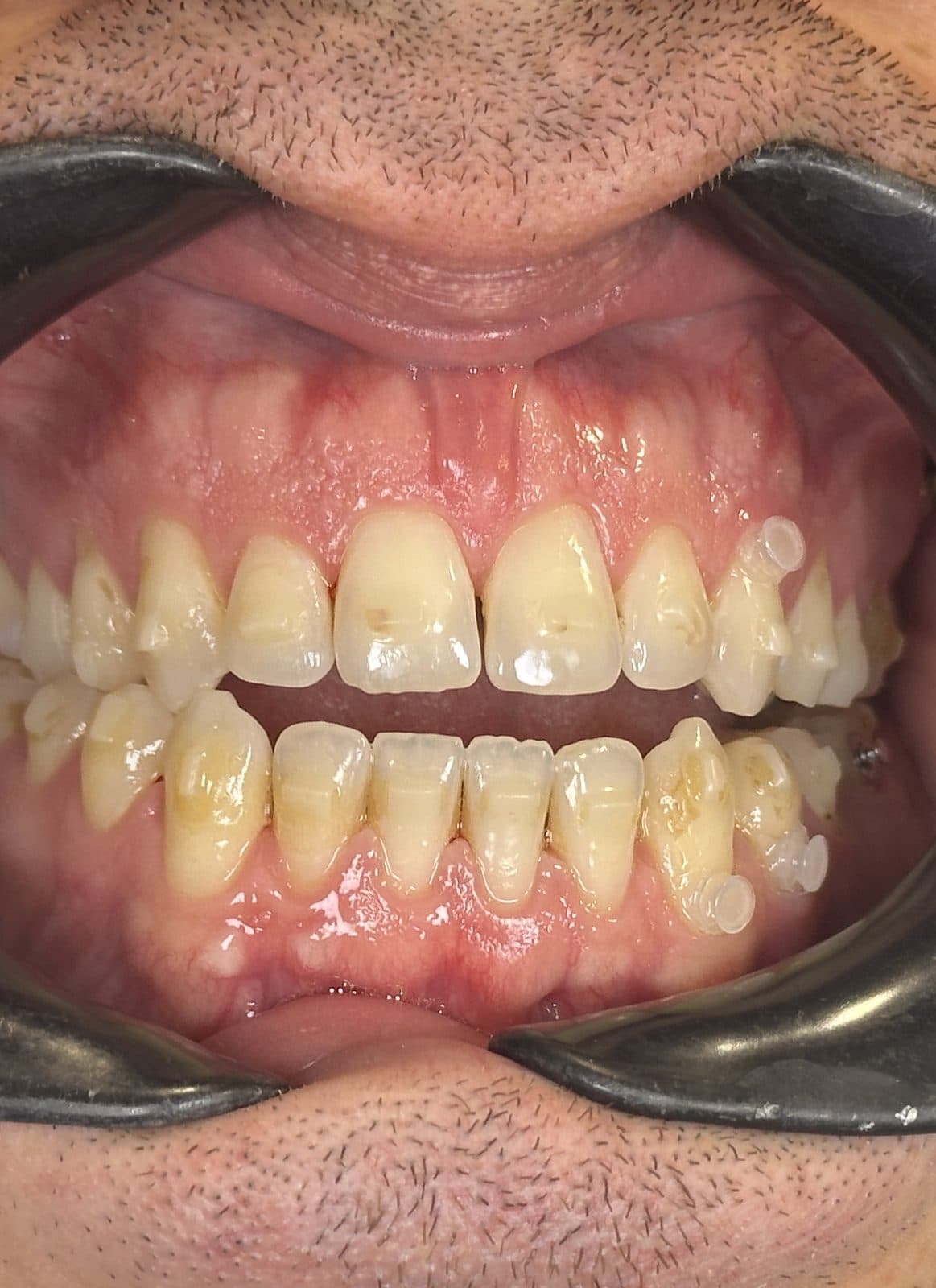 Before: close-up of teeth and gums
